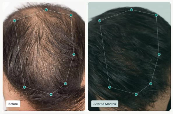 Weight Loss Cleveland TN Nutrafol Men's Before And After